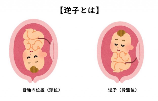 逆子のイラスト